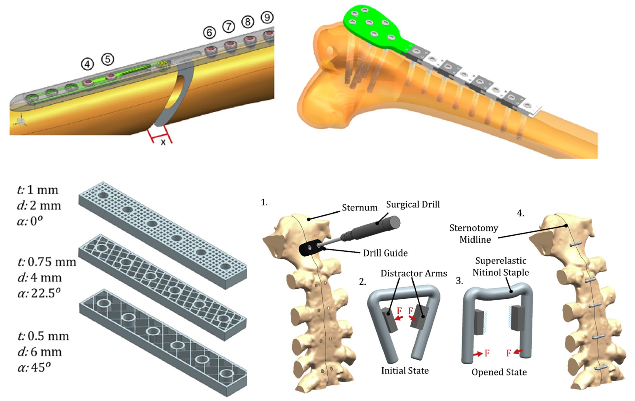 Orthopaedic implant design